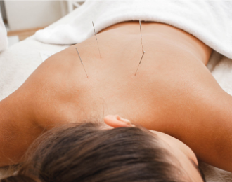 Acupuntura